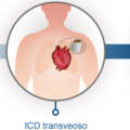 Differenza tra ICD e defibrillatore